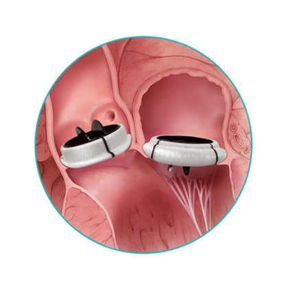 Prótesis Válvular Cardíaca
